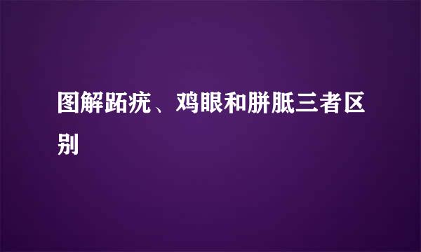 图解跖疣、鸡眼和胼胝三者区别